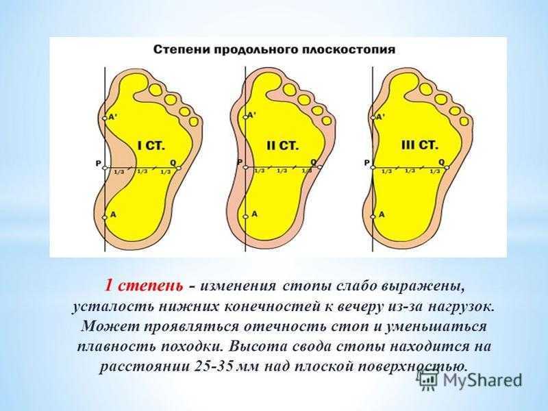 Поперечное плоскостопие 2 степени