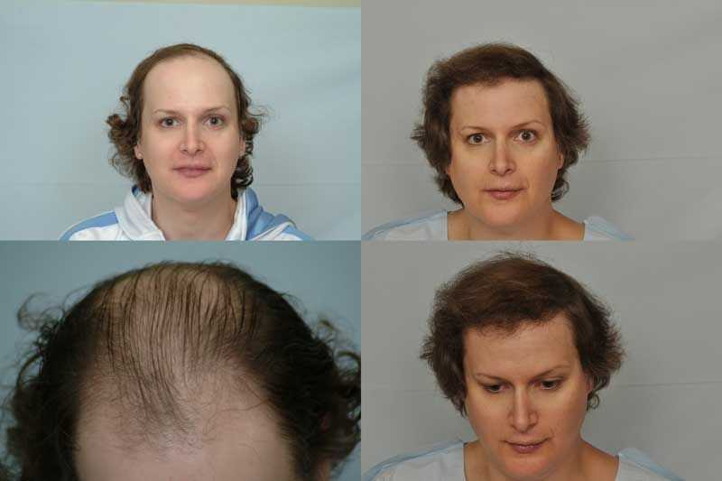 Выпадают волосы после операции. Трансплантация волос до и после. Трансплантация волос у женщин. До и после пересадки волос женщины. Прически при облысении.