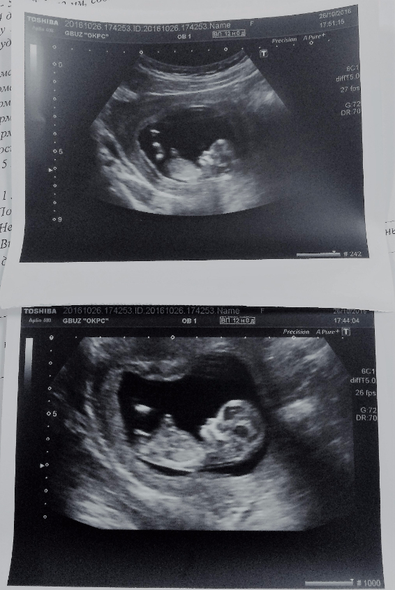 13 недель беременности фото сколько месяцев