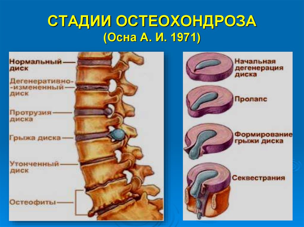 Мр картина остеохондроза шейного отдела позвоночника