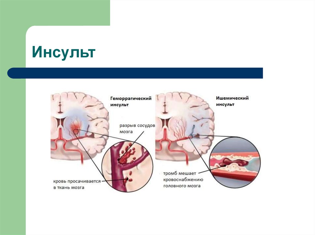 Геморрагический инсульт первые признаки