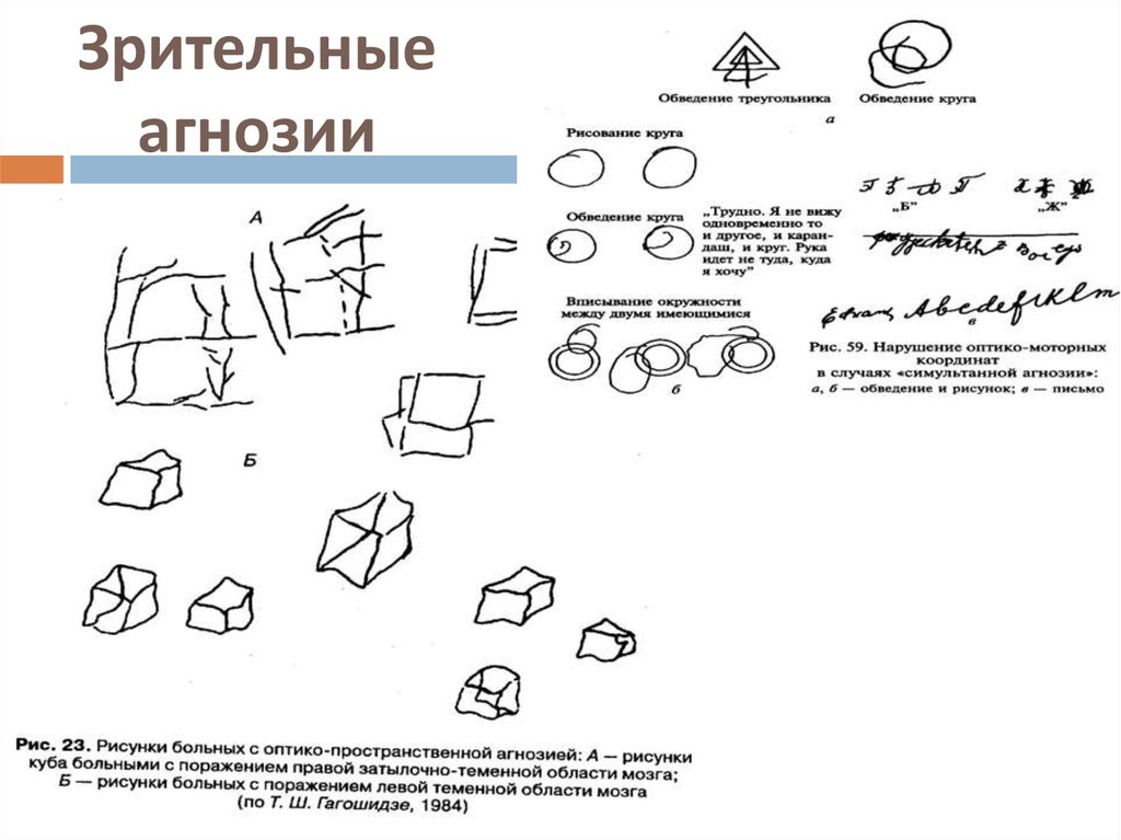 Вид агнозии характеризующийся нарушением узнавания предметов или их изображений