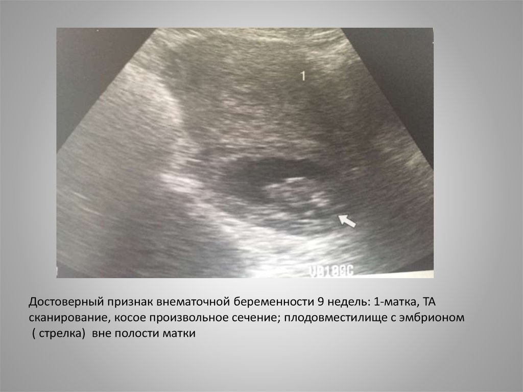 Беременность после внематочной отзывы. Внематочная беременность. Внематочная беременность на УЗИ. Внематочная беременность симптомы. Трубная беременность УЗИ.