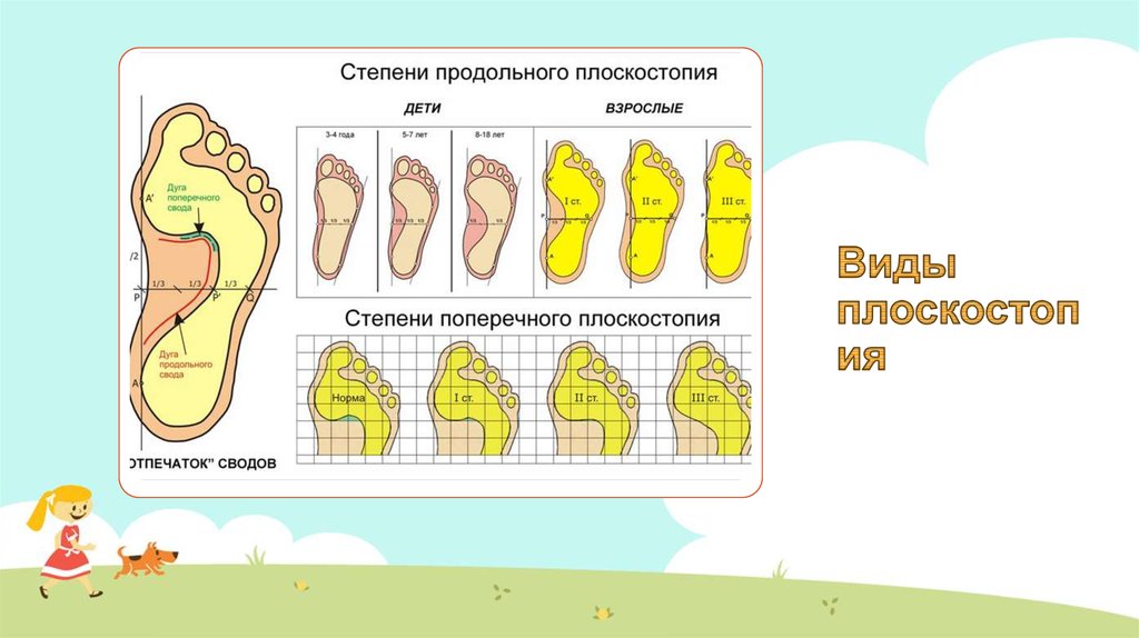 Степени плоскостопия таблица с картинками