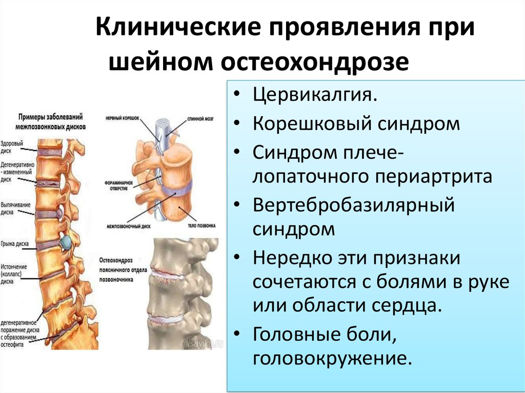 Карта вызова скорой медицинской помощи остеохондроз шейного отдела позвоночника