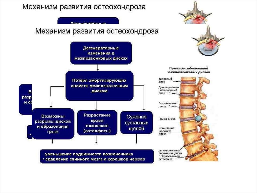 Схема лечения обострения остеохондроза