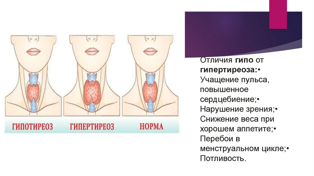 Гипо и гипертиреоз. Гипертиреоз щитовидной железы. Различия гипо и гипертиреоза. Симптомы гипо и гипертиреоза.