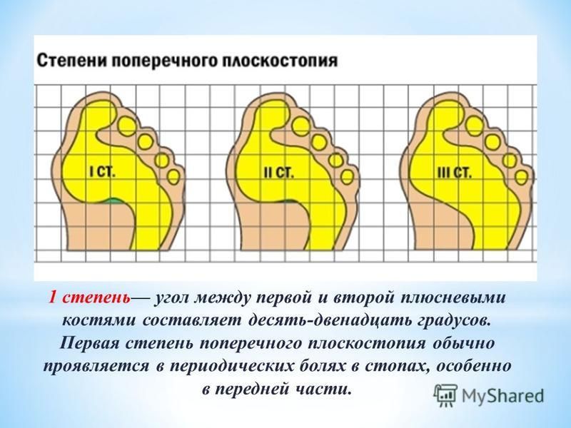 Что такое поперечное плоскостопие как лечить у взрослых фото