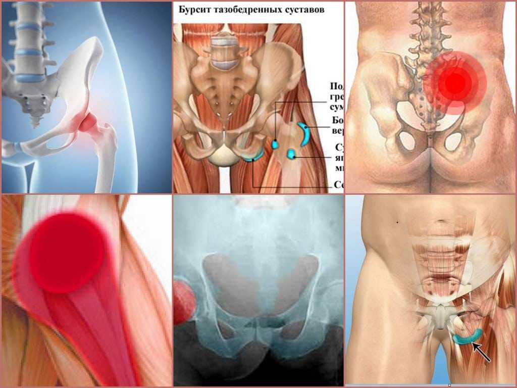 Боль бедра в тазобедренном суставе. Бурсит тазобедренного сустава. Бурсит трохантерит тазобедренного сустава симптомы. Подвздошно-гребешковая сумка тазобедренного сустава. Бдль тазобедренный сустав.