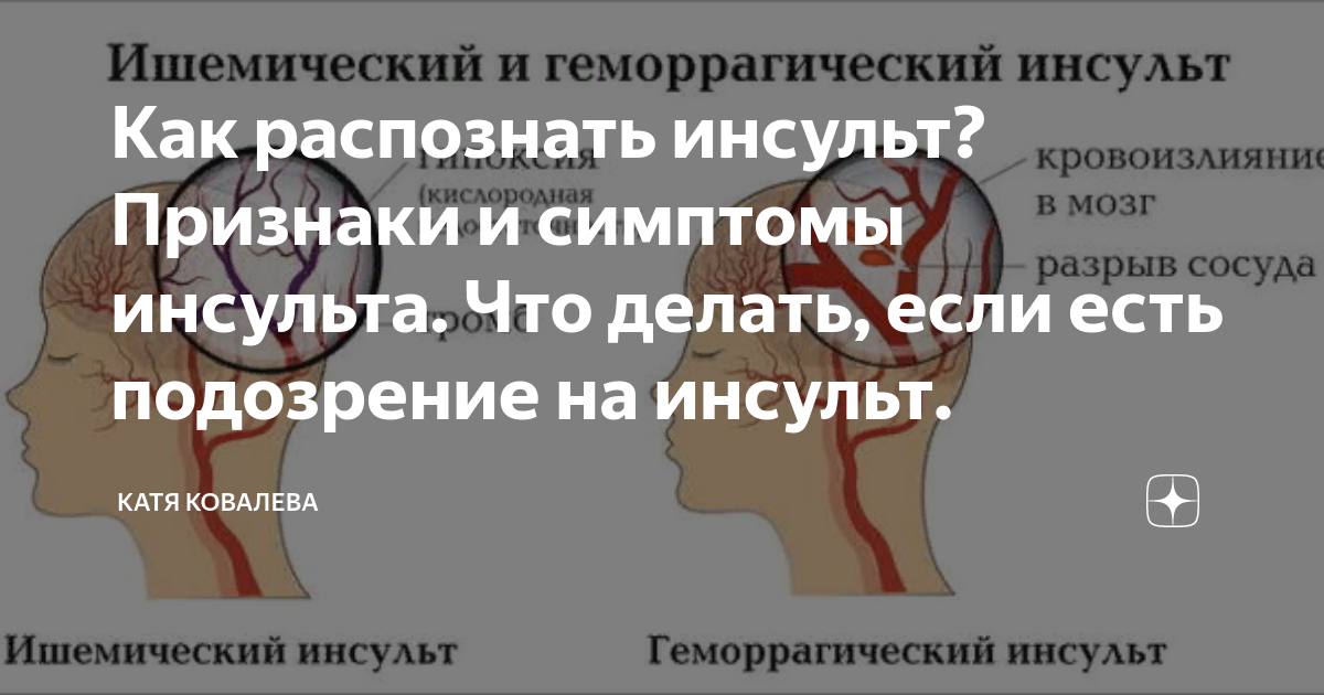 Инсульт у женщин. Подозрение на инсульт. Как распознать инсульт. Инсульта головного мозга у женщин. Три приема распознавания инсульта.