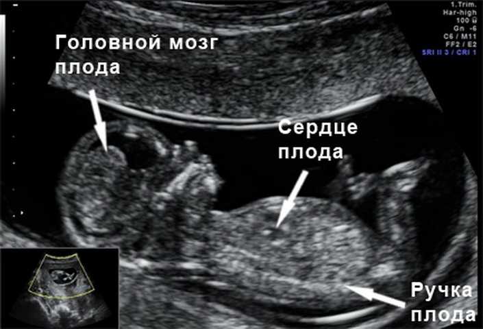 Узи мозга плода. Эмбрион на 11 неделе беременности УЗИ. УЗИ 11 недель беременности. 11 Недель беременности по УЗИ. УЗИТ на 11 неделе беременности.