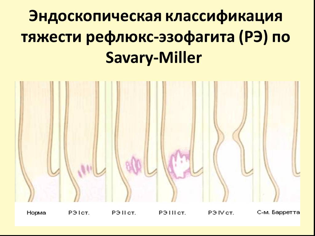 Классификации эндоскопия. Рефлюкс эзофагит эндоскопическая классификация. Классификация Савари Миллера ГЭРБ. Классификация Savary-Miller рефлюкс-эзофагита. ГЭРБ классификация Savary-Miller.