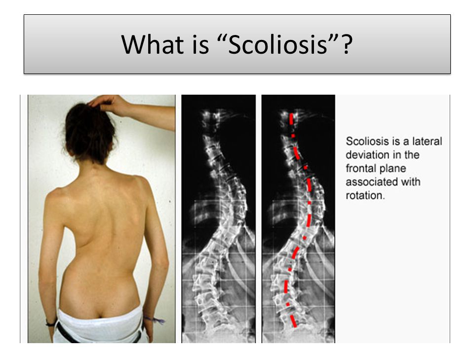 Склероз таза. Сколиоз позвоночника 3 степени. Грудопоясничный сколиоз 4 степени. Сколиоз позвоночника 2-3.