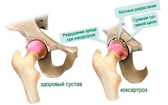 Болит правая ягодица за рулем