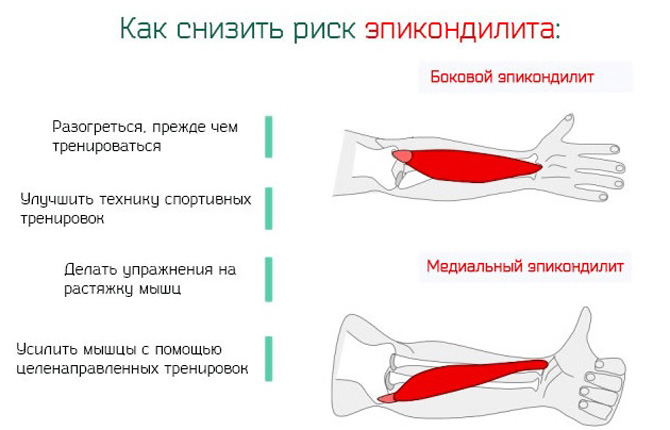 Гимнастика при эпикондилите локтевого сустава картинки