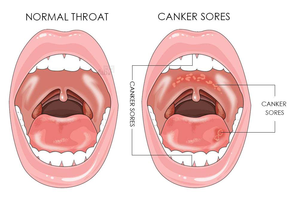 Сыпь температура боль в горле у ребенка