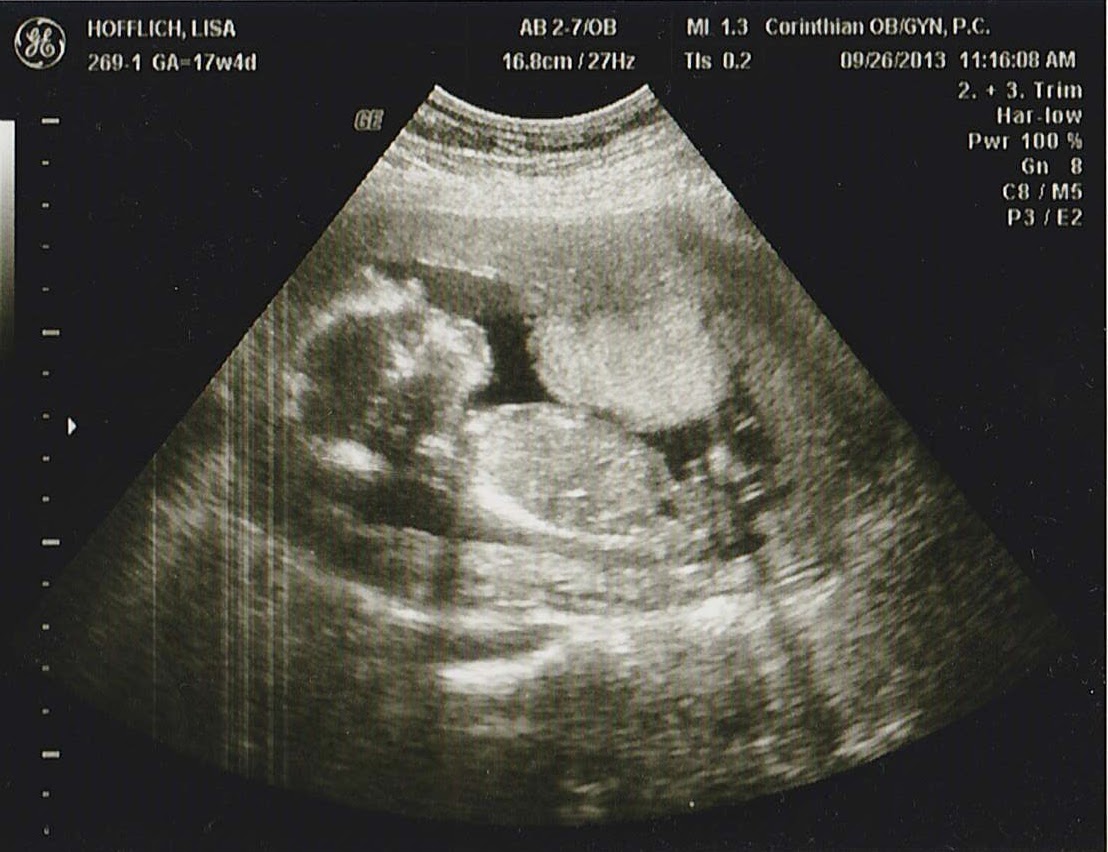 Тонус передней стенки матки. Снимки УЗИ. УЗИ беременности на ранних. Миома матки при беременности УЗИ.