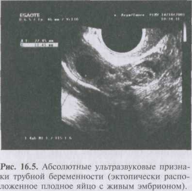 Узи при внематочной беременности на ранних сроках фото