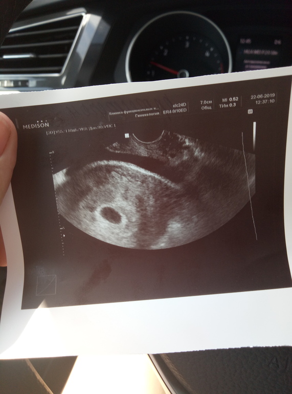 Как выглядит узи на 6 неделе. УЗИ на 5-6 неделе беременности акушерская. 6 Акушерских недель беременности на УЗИ. УЗИ на 5 акушерской неделе беременности. УЗИ на 5 5 неделе беременности эмбрион.