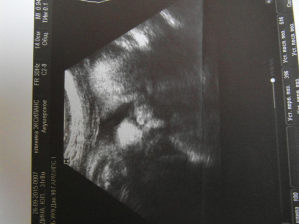 Насморк 38 недель. Снимок УЗИ беременности 39 недель.