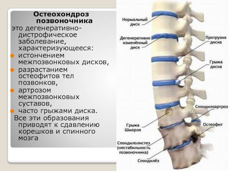 Остеохондроз грудного отдела карта смп