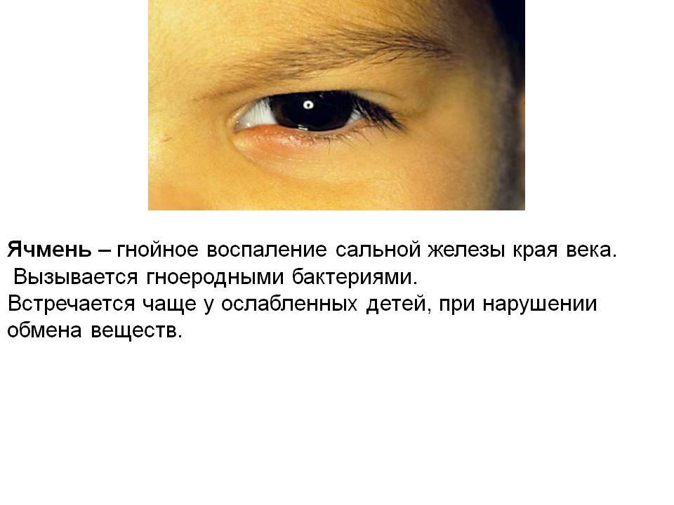 Как вылечить ячмень у ребенка на глазу. Стадии ячменя на глазу в картинках развития. Ячмень заболевание презентация.