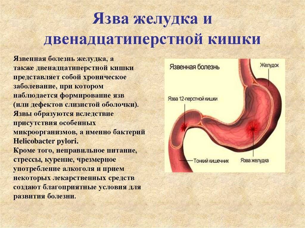 Схема лечения язвенной болезни желудка и двенадцатиперстной