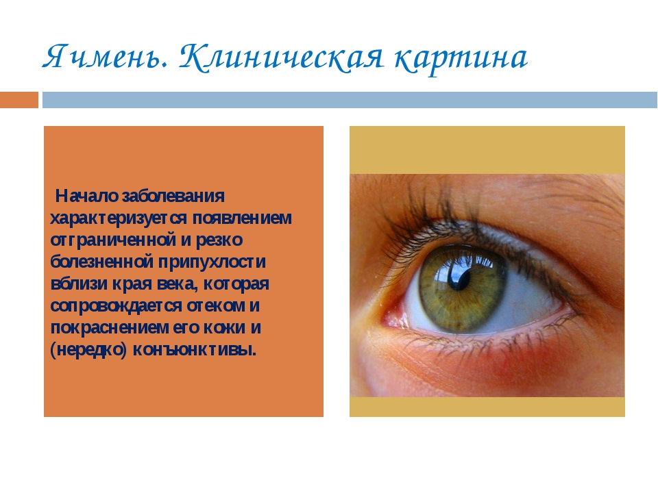 Как вылечить ячмень у ребенка на глазу. Заболевания век ячмень. Клинические проявления ячменя. Этапы развития ячменя на глазу. Этапы формирования ячменя на глазу.
