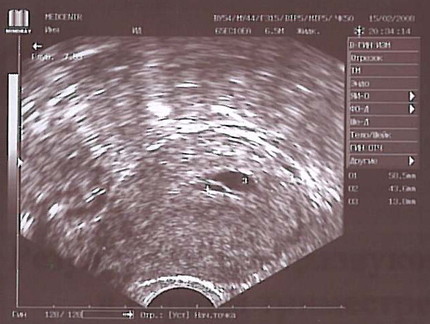 Эндометрий при переносе эмбриона. УЗИ беременности 5 недель эндометрий. УЗИ беременности 4 недели эндометрия. УЗИ матки на 5 неделе беременности. Эндометрий 3 недели беременности на УЗИ.