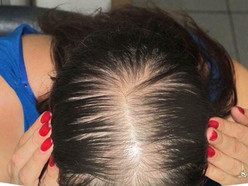 После коронавируса выпадают волосы. Андрогенетическая алопеция у женщин. Андрогенная алопеция алопеция. Залысины у женщин. Поредение волос у женщин.