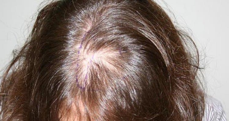 Почему выпадают волосы при туберкулезе