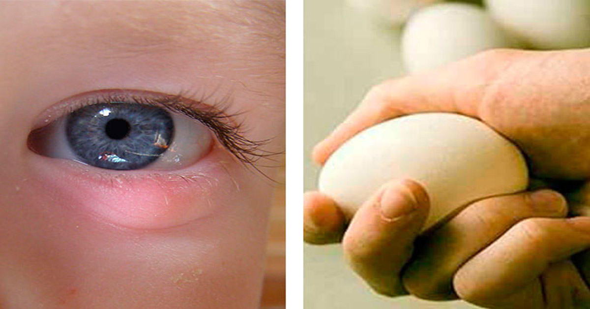 Как вылечить ячмень у ребенка на глазу