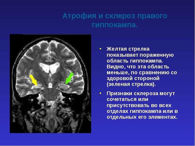 Мезиальный темпоральный склероз. Гиппокамп анатомия мрт. Темпоральный склероз гиппокампа. Склероз гиппокампа мрт. Склероз гиппокампа кт.