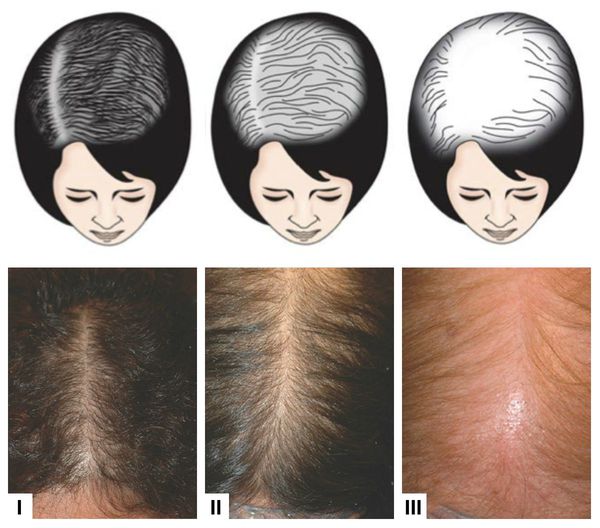 Как внутренние органы влияют на выпадение волос у женщин