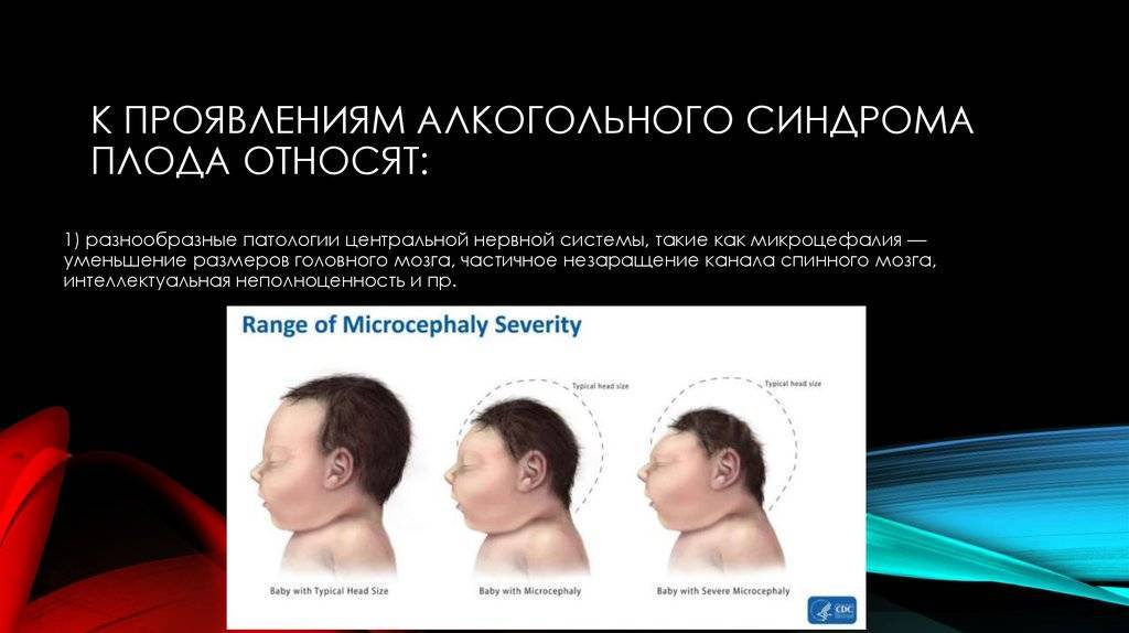 Алкогольный синдром картинки