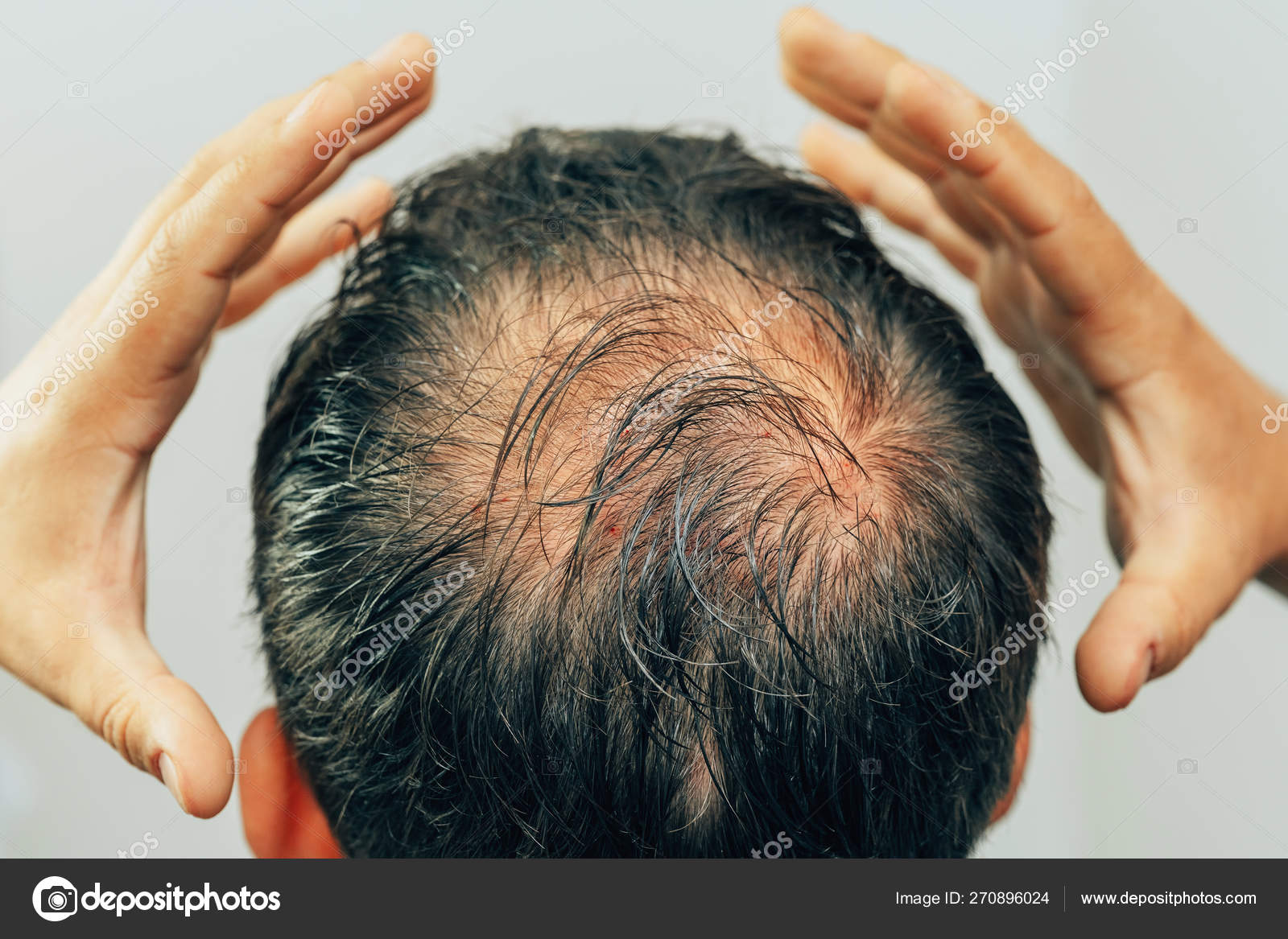 Выпадение волос головы причина лечение. Прозрачные волосы на голове.