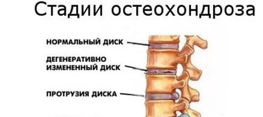 Симптомы остеохондроза поясничного отдела у мужчин. Степени остеохондроза грудного. Остеохондроз гоп. Остеохондроз поясничного отдела позвоночника 2 ст. Остеохондроз грудного отдела позвоночника 2 ст.