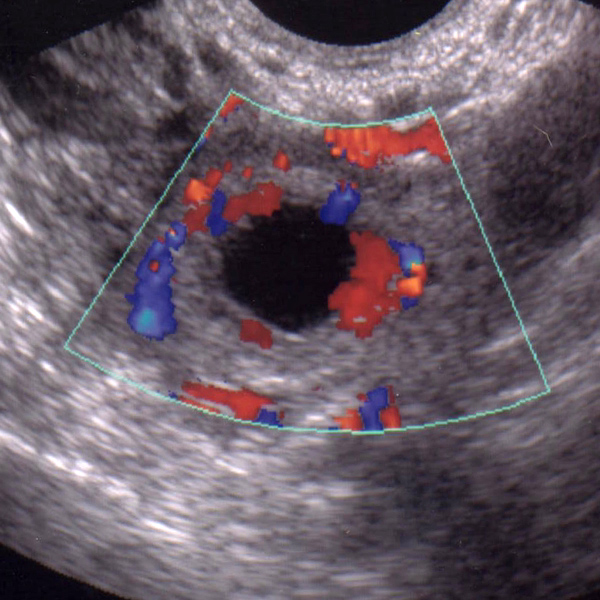 На узи видно внематочную. Ложное плодное яйцо на УЗИ. Внематочная беременность 6 недель УЗИ. Внематочная беременность 5-6 недель УЗИ. Анэмбриония – пустое плодное яйцо.