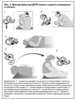 Дппг головокружение гимнастика. Вестибулярная гимнастика при головокружении Эпли. Маневры Эпли при головокружении. Гимнастика при головокружении ДППГ.