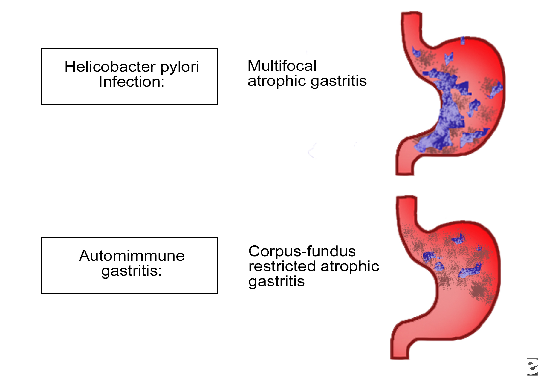 Что такое аутоиммунный гастрит. Патогенез гипоацидного гастрита. Хронический гастрит аутоиммунный механизм развития. Аутоиммунный гастрит патогенез. Хронический атрофический гастрит патогенез.