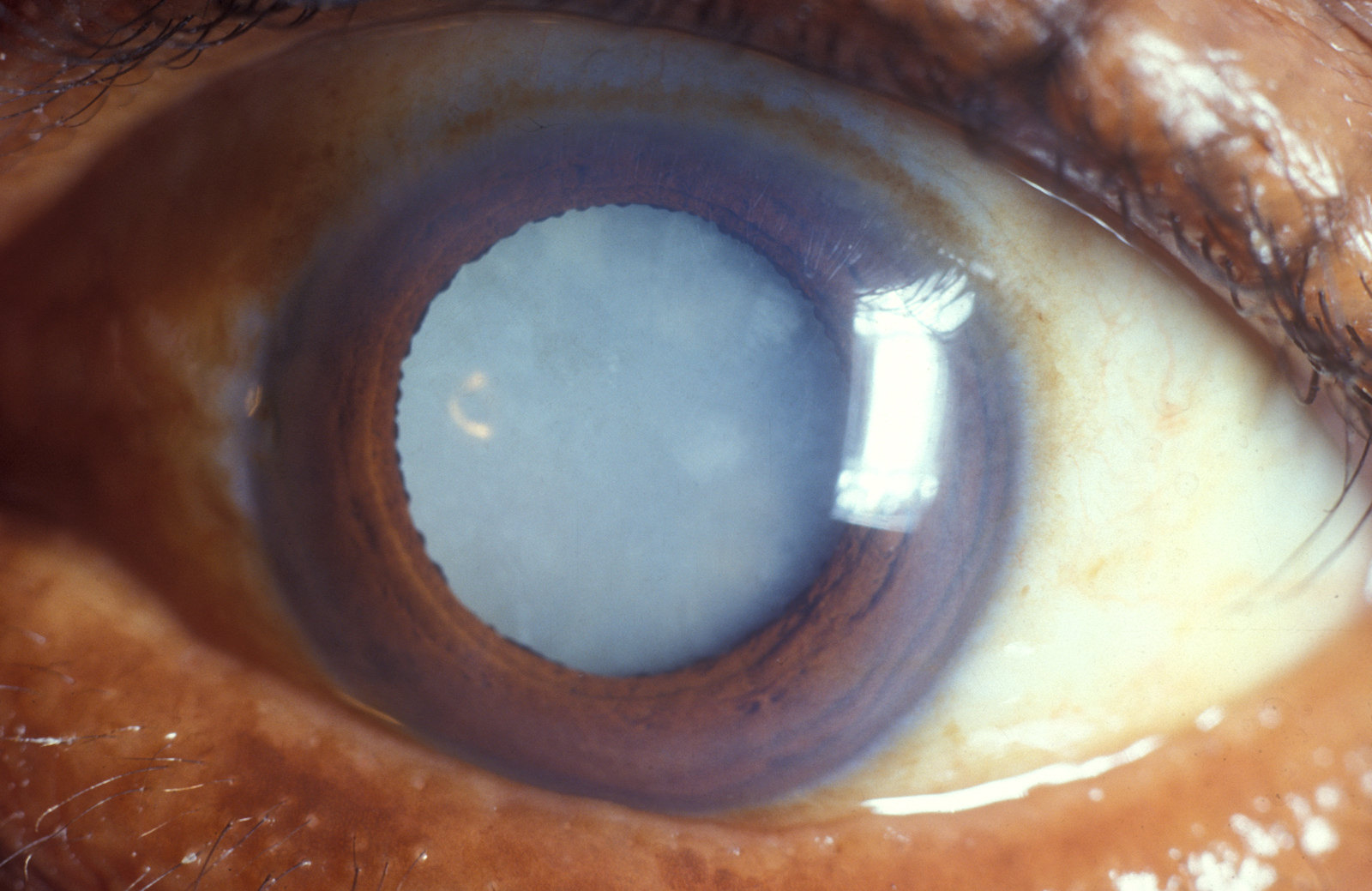 Вторичная катаракта после операции. Постувеальная катаракта. Сенильная катаракта глаза. Миопизирующая катаракта.